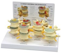 4 Stages of Lumbar Degeneration - Vertebrae Models