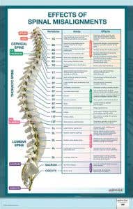 Bodypartchart Effects Of Spinal Misalignment