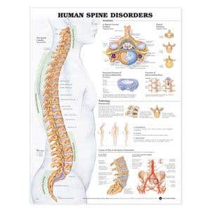 Human Spinal Disorders Poster - 20 x 26 Laminate