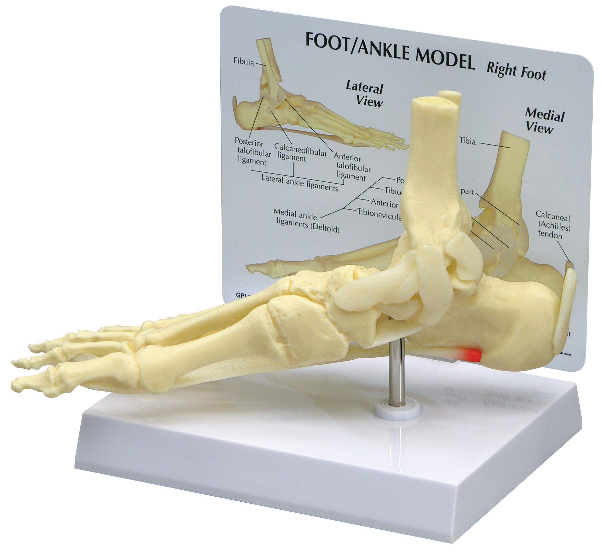 Ankle/Foot Plantar Fasciitis with Key Card
