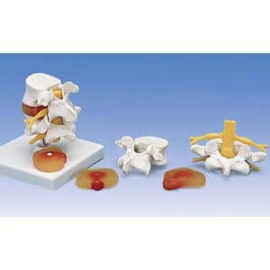 Lumbar Spinal Column W/Prolapsed Intevertebral Dsc