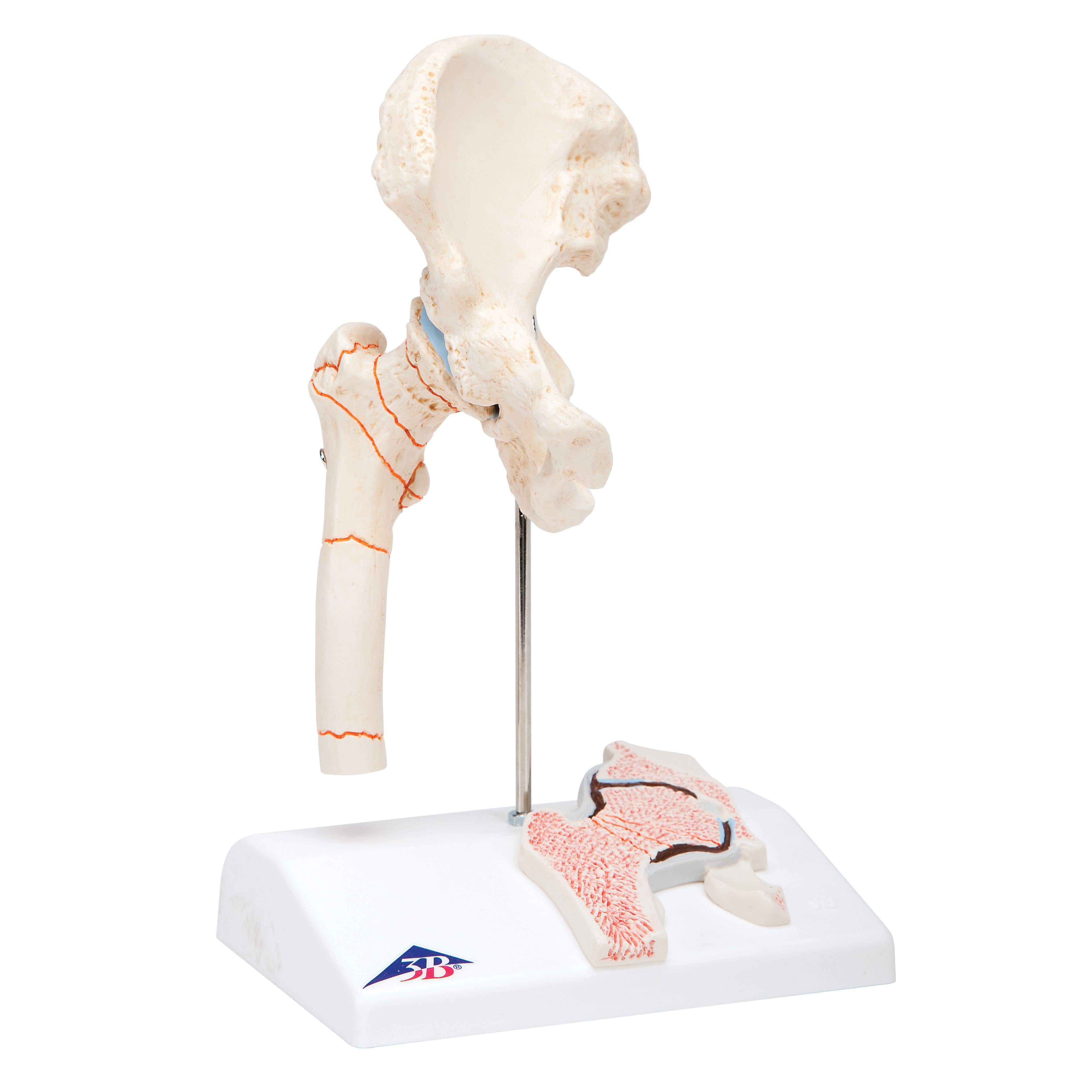 American 3b Scientific Femoral Fracture and Hip Model